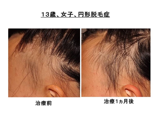 円形脱毛症　病院""